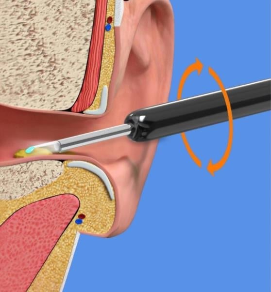 🔥48%OFF🔥Localityi™ Clean Earwax-Wi-Fi Visible Wax Removal Spoon, USB 1296P HD Load Otoscope